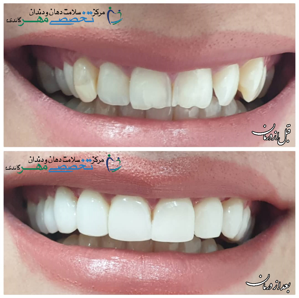 دکتر نسترن مختاری - متخصص ترميمی و زیبایی (کامپوزیت ونیر / لمینیت کامپوزیتی)