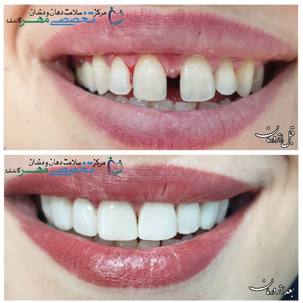 دکتر نسترن مختاری - متخصص ترميمی و زیبایی (کامپوزیت ونیر / لمینیت کامپوزیتی)