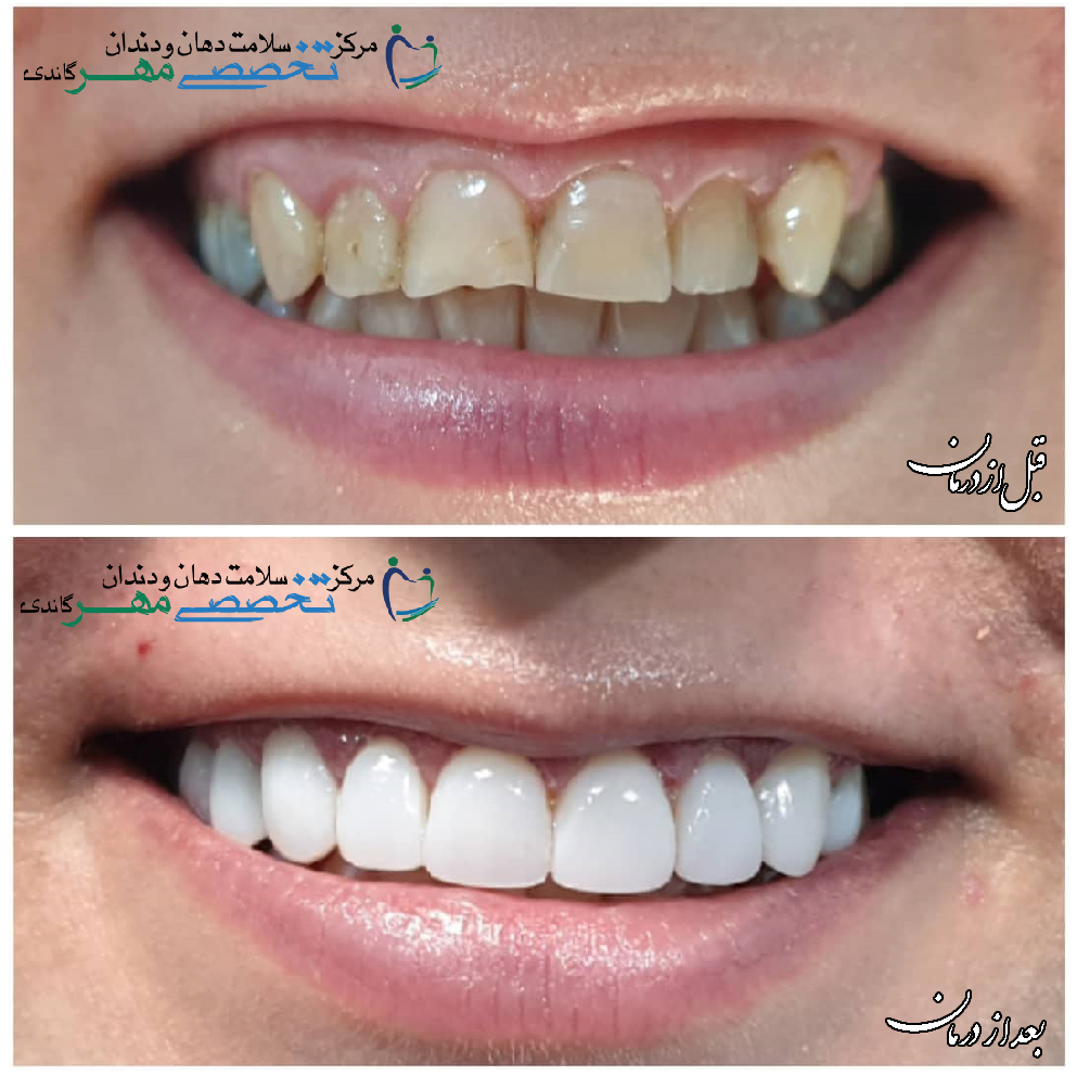 دکتر نسترن مختاری - متخصص ترميمی و زیبایی (کامپوزیت ونیر / لمینیت کامپوزیتی)