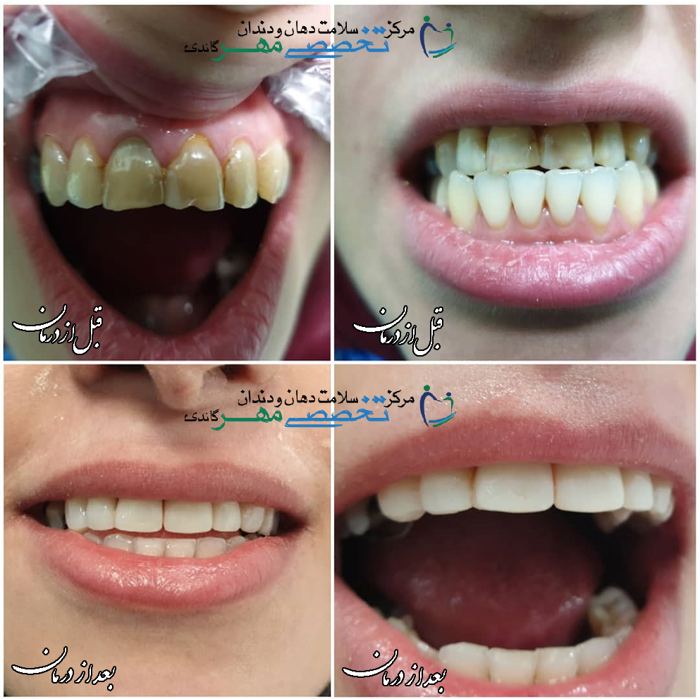 دکتر نسترن مختاری - متخصص ترميمی و زیبایی (کامپوزیت ونیر / لمینیت کامپوزیتی)
