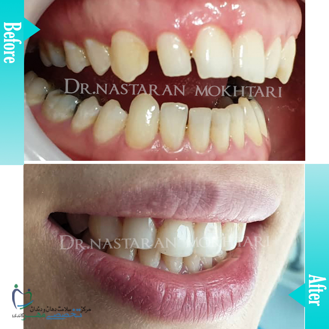دکتر نسترن مختاری - متخصص ترميمی و زیبایی (کامپوزیت ونیر / لمینیت کامپوزیتی)