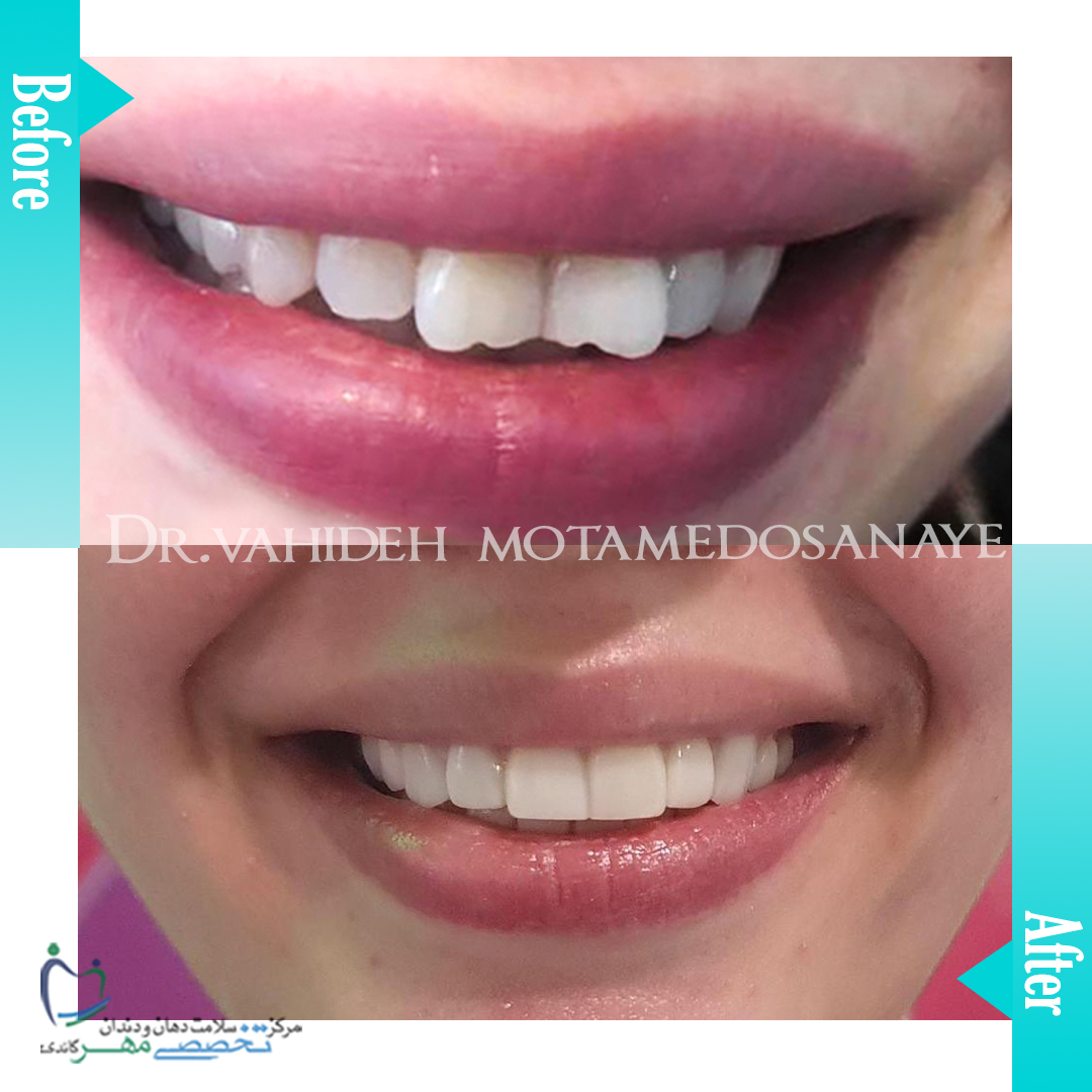 دکتروحیده معتمد الصنایع - متخصص ترميمی و زیبایی (کامپوزیت ونیر / لمینیت کامپوزیتی)